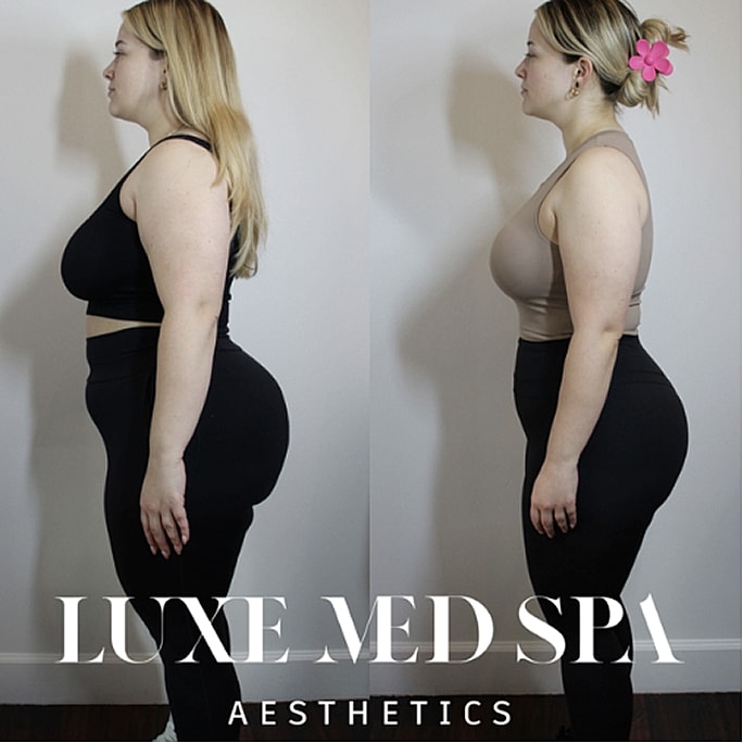 Before and after body sculpting transformation.